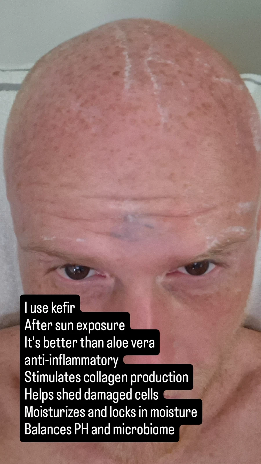 Scalp and forehead with topical kefir applied, with notes on kefir benefits
