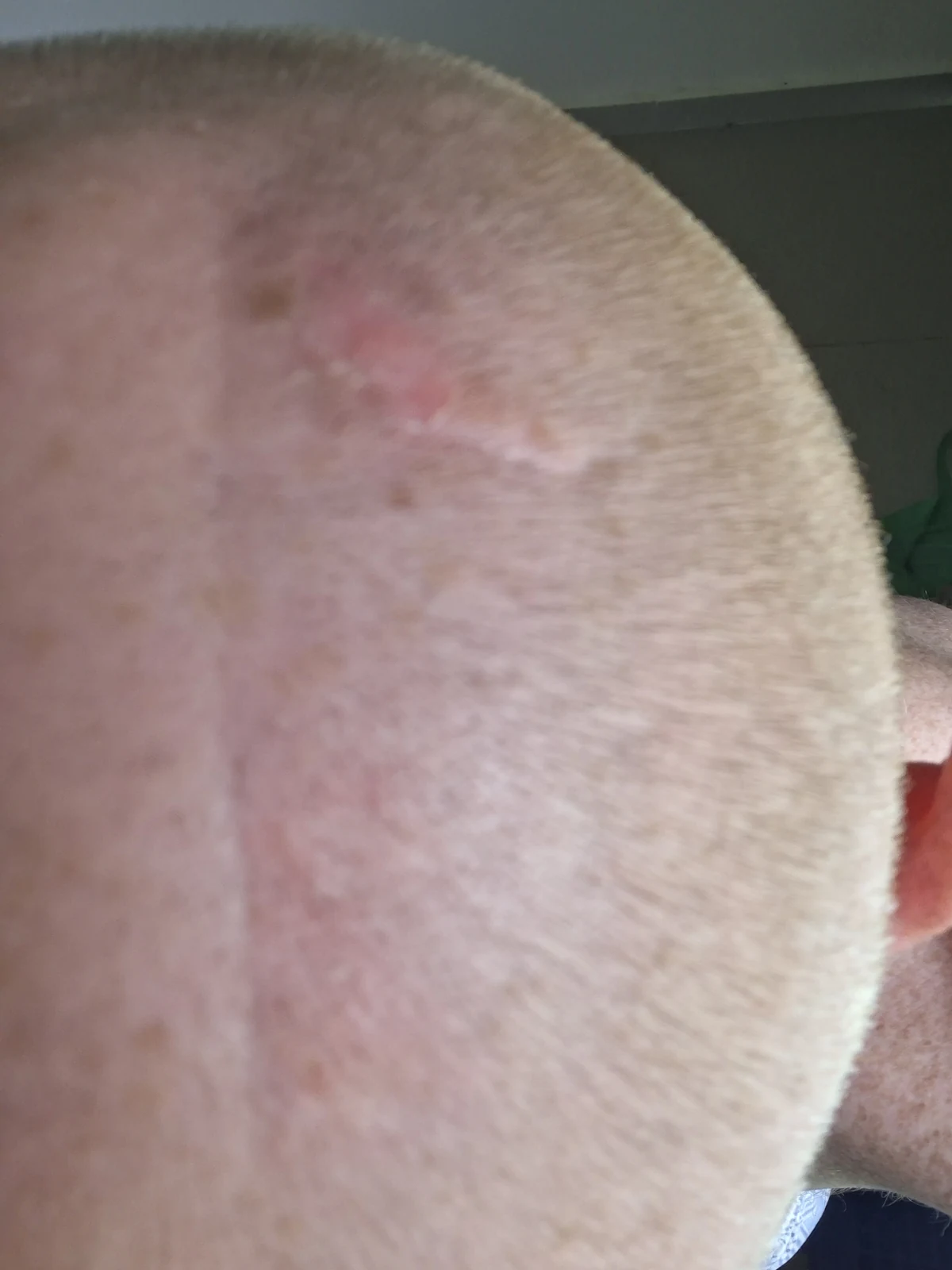 Close-up of scalp showing a raised pink patch of skin amid short buzzed hair