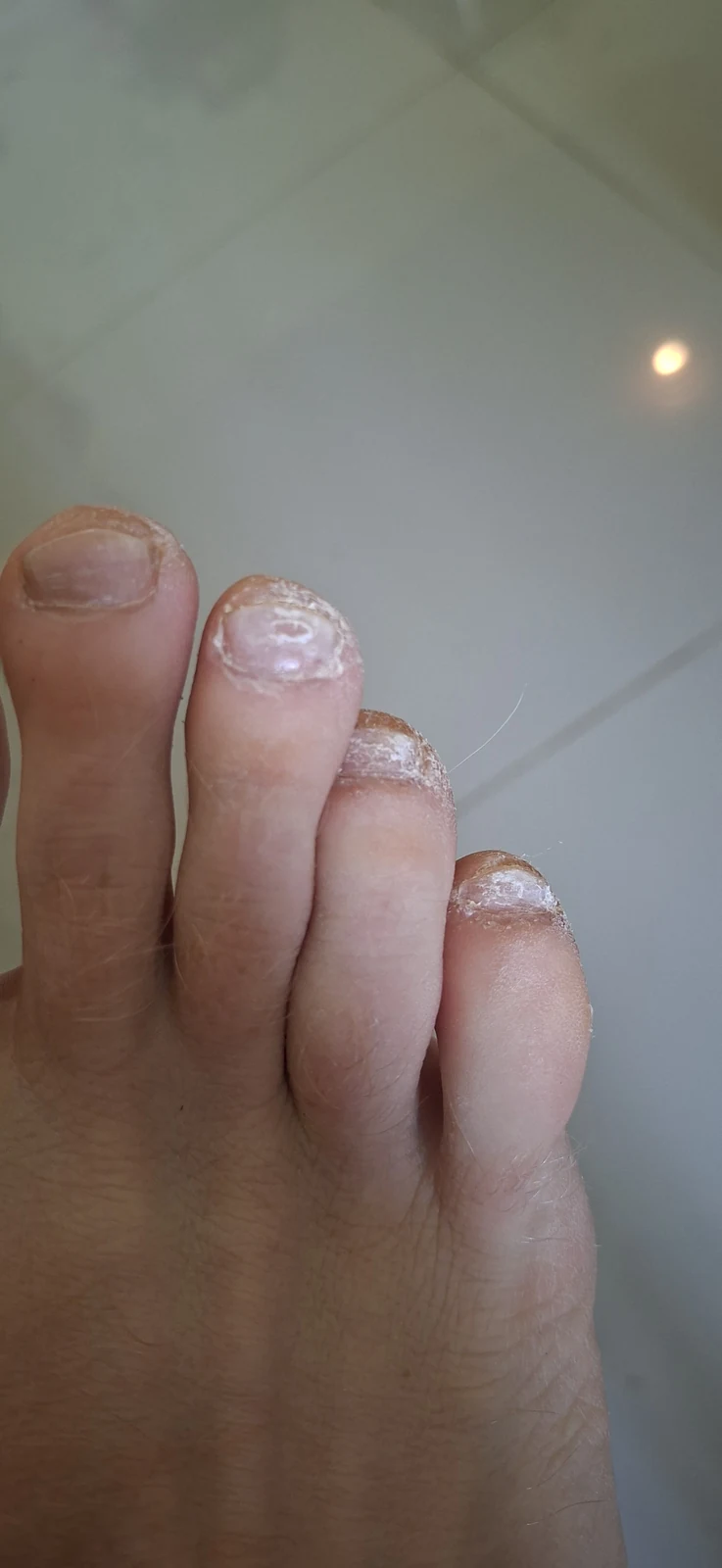Close-up of four toes with thick white fungal debris on the toenails